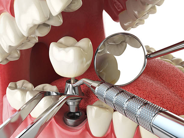 Best Emergency Dental Care for Abscessed Tooth in Logan, IA
